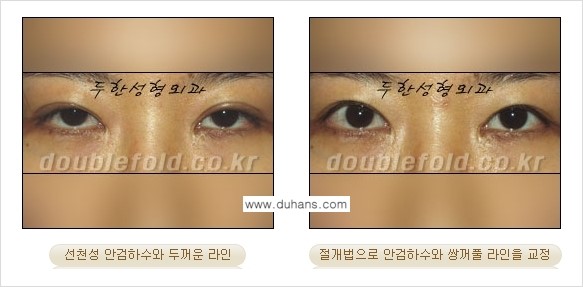 [두한성형외과 NO.1 "극한 눈(쌍꺼풀 재수술)"] - [안검하수(졸린눈매) 재수술 안내 3.] 관련 이미지 5