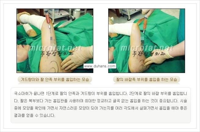 [두한성형외과 경쟁력 맞춤 바디성형] - [간편한 아랫배, 윗배, 허리, 옆구리살, 허벅지, 엉덩이, 복부지방흡입술, 팔뚝(상완부) 지방흡입술 안내] 관련 이미지 7