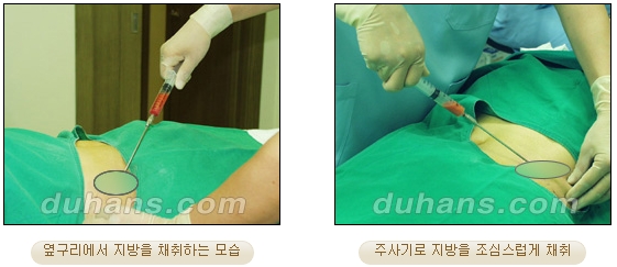 [두한성형외과 얼굴자가지방이식] - [볼살, 이마, 측두부] 관련 이미지 4