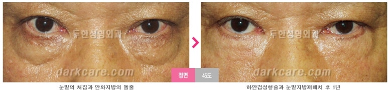[두한성형외과 눈밑수술] - [눈밑지방재배치의 적응증] 관련 이미지 6