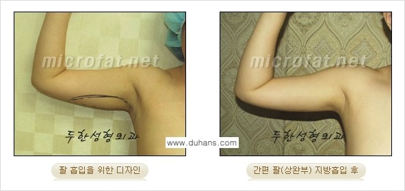 [두한성형외과 간편 지방흡입] - [팔, 팔뚝, 팔뚝살, 상완부 지방흡입 시술의 예] 관련 이미지 2