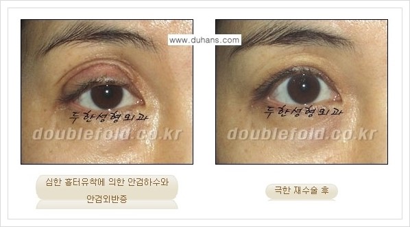 [두한성형외과 경쟁력 쌍꺼풀 재수술, 극한 눈재수술] - [쌍꺼풀 재수술, 극한 눈재수술 관련 자주하는 질문과 답변] 관련 이미지 6