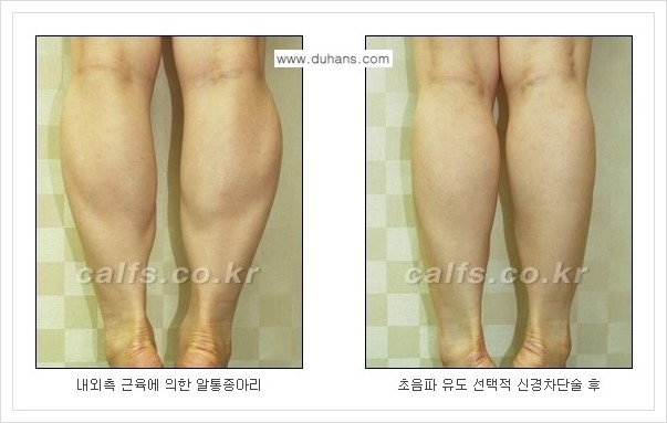 [두한성형외과 경쟁력 멀티종아리성형] - [나에게 맞는 종아리성형 방법의 종류 안내 2.] 관련 이미지 2
