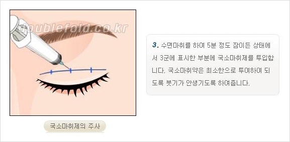 [두한성형외과 경쟁력 쌍꺼풀 재수술, 극한 재수술] - [쌍꺼풀 재수술의 과정 안내 2.] 관련 이미지 6
