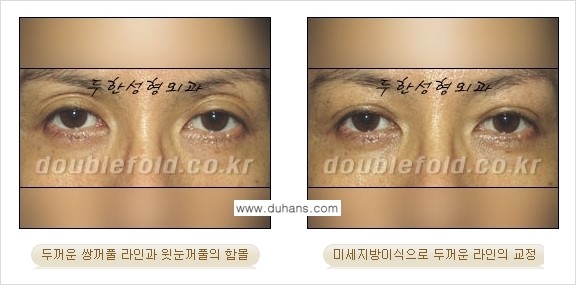 [두한성형외과 경쟁력 눈성형] - [미세지방이식으로 두꺼운 쌍꺼풀 라인의 교정 방법 안내] 관련 이미지 4