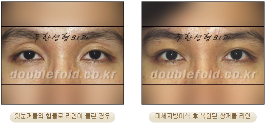 [Eye Reoperation Duhan Plastic Surgery] - [Guide to Double Eyelid Revision Surgery] image 64