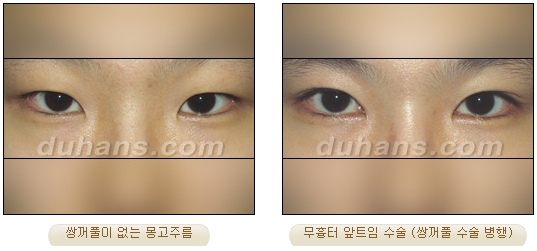[Duhan Plastic Surgery Double Eyelid Surgery] - [Types of Double Eyelid Surgery] image 38