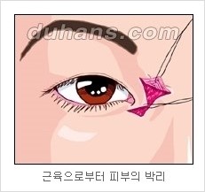 쌍커풀수술 두한성형외과 - 나에게 맞는 눈성형은? 관련 이미지 56