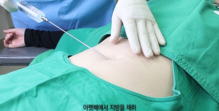 [Duhan Plastic Surgery Eye Area Surgery] - [Dark Circles and Aegyo-sal] image 8