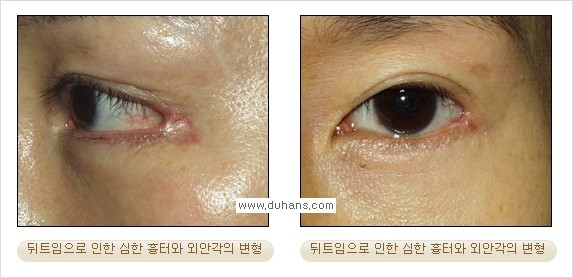 [두한성형외과 경쟁력 쌍꺼풀 재수술, 극한 눈재수술] - [뒤트임 수술의 부작용 안내] 관련 이미지 3