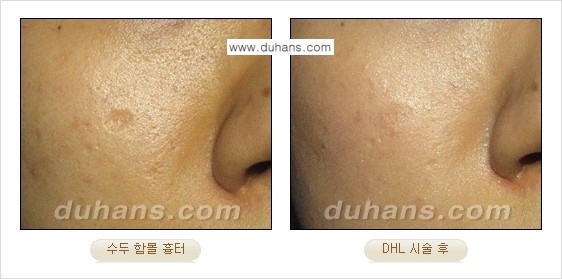 [두한성형외과 함몰 흉터 교정] - [동시에 3가지 시술로 효과적인 흉터의 교정 안내 ②] 관련 이미지 6