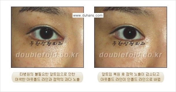 [두한성형외과 경쟁력 쌍꺼풀 재수술] - [과도한 앞트임이 되었을 경우 안내] 관련 이미지 1