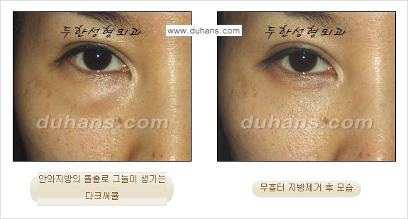 [두한성형외과 젊은 눈매 안검성형] - [눈밑 지방제거의 수술 전후 안내 ①] 관련 이미지 18