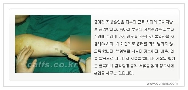 [두한성형외과 경쟁력 멀티종아리성형] - [매력적인 종아리 - 정교한 미세흡입관 지방흡입 안내] 관련 이미지 7