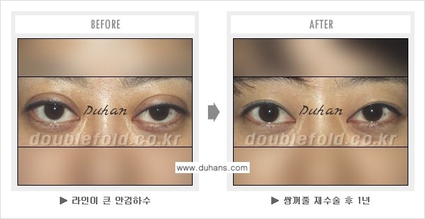 [두한성형외과 경쟁력 쌍꺼풀 재수술, 극한 재수술] - [쌍꺼풀 재수술로 인해 흉살이 두터운 경우] 관련 이미지 3