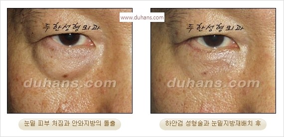 [두한성형외과 경쟁력 안검성형] - [눈밑주름 제거수술] 관련 이미지 6