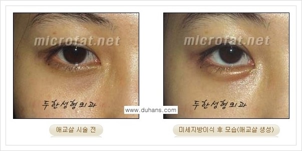 [두한성형외과 경쟁력 눈밑성형] - [눈밑 애교살 미세지방이식 안내] 관련 이미지 12