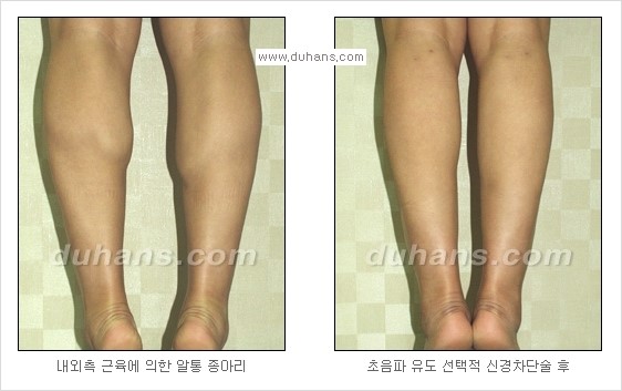 [두한성형외과 경쟁력 멀티종아리성형] - [종아리 퇴축수술 방법들의 문제점] 관련 이미지 13