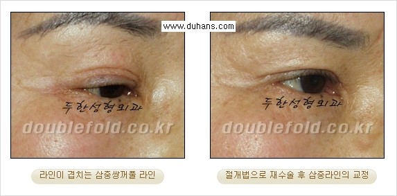 [두한성형외과 경쟁력 눈성형] - [삼중(세겹) 쌍꺼풀 라인의 교정] 관련 이미지 9