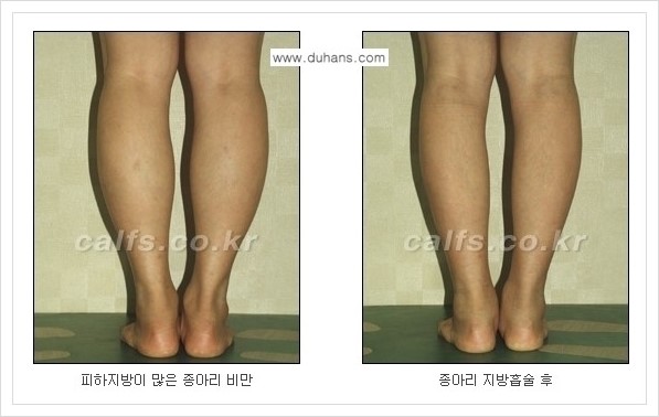 [두한성형외과 경쟁력 멀티종아리성형] - [정교한 미세흡입관 종아리 지방흡입술] 관련 이미지 11