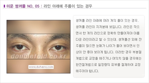 [두한성형외과 경쟁력 눈성형] - [나에게 맞는 맞춤 쌍꺼풀 찾기] 관련 이미지 5