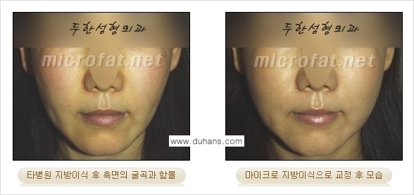[두한성형외과 경쟁력 미세지방이식] - [타 병원에서 볼살 지방이식 이후 부작용 교정 방법 안내] 관련 이미지 4