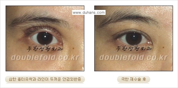 [두한성형외과 NO.1 경쟁력 눈성형] - [일반 쌍꺼풀 재수술과 극한 눈(쌍꺼풀) 재수술과의 차이점] 관련 이미지 12