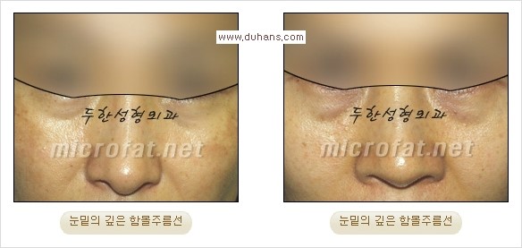 [두한성형외과 경쟁력 눈밑성형] - [Dr. 컬럼 - 눈밑 다크써클의 치료 방법과 치료 효과] 관련 이미지 14