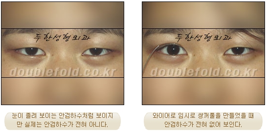 [Duhan Plastic Surgery Double Eyelid Revision Surgery] - [Ptosis, sausage eyelids] image 5