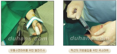 [두한성형외과 안전한 지방흡입] - [얼굴지방흡입] 관련 이미지 7