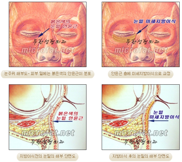 [두한성형외과 지방이식] - [다크써클, 눈​밑주름] 관련 이미지 5