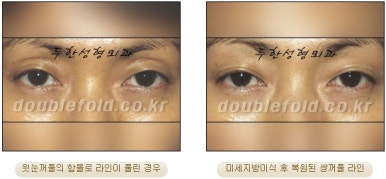 [두한성형외과 눈성형] - [풀린 쌍커풀 재수술] 관련 이미지 12