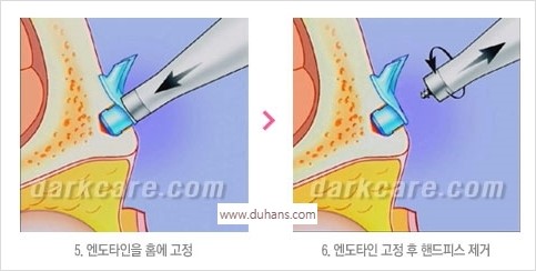 [두한성형외과 경쟁력 동안성형 리더] - ​[미간주름, 이마주름, 안검성형, 이마거상술, 눈썹거상술] 관련 이미지 128