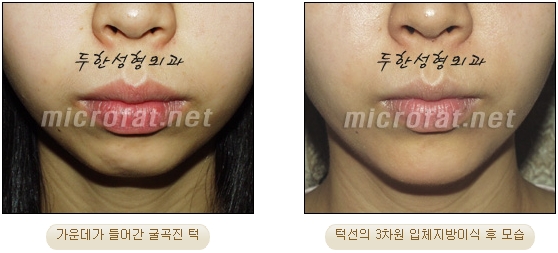 [두한성형외과 미세지방이식] - [무턱교정 안내] 관련 이미지 17