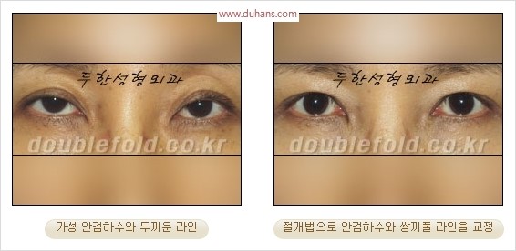 [두한성형외과 경쟁력 눈성형] - [극한 재수술, 함몰된 눈꺼풀 라인교정, 안검하수(졸리운 눈매)] 관련 이미지 98