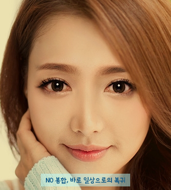 [Duhan Plastic Surgery Double Eyelid Surgery] - [Double Eyelid Guide] image 6
