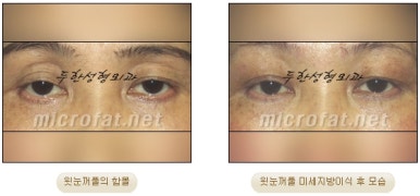 [Doohan Plastic Surgery Autologous Fat Grafting] - [Sunken Eye Fat Grafting] image 15
