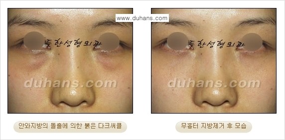 [두한성형외과 젊은 눈매 안검성형] - [눈밑 지방제거의 수술 전후 안내 ②] 관련 이미지 7