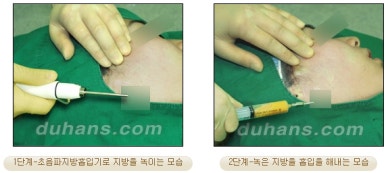 [두한성형외과 안전한 지방흡입] - [얼굴지방흡입] 관련 이미지 8