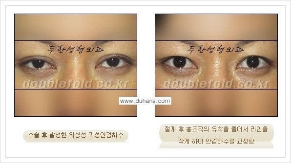 [두한성형외과 경쟁력 쌍꺼풀 재수술(극한 재수술)] - [안검하수(졸리운 눈매) 교정 안내 1.] 관련 이미지 11