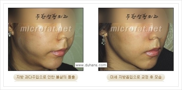 [두한성형외과 경쟁력 미세지방이식] - [볼살 지방이식 - 타병원 지방이식 후 과주입으로 인해 볼살이 불룩한 경우] 관련 이미지 5