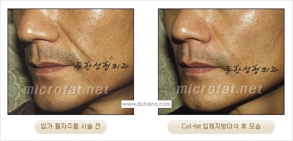 [두한성형외과 경쟁력 지방이식] - [두한 자가지방이식 클리닉 안내]​ 관련 이미지 47