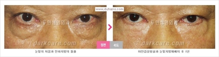 [두한성형외과 경쟁력 눈밑성형] - [Dr. 컬럼 "눈밑 지방재배치의 문제점"] 관련 이미지 6