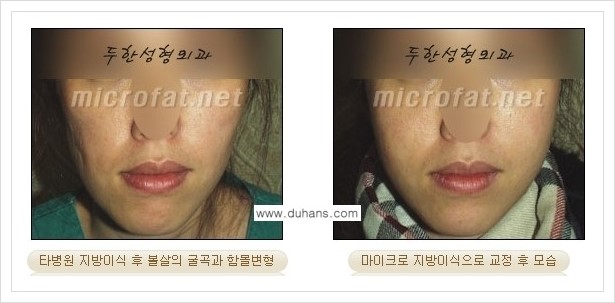 [두한성형외과 경쟁력 볼살지방이식] - [타병원 지방이식 후 - 굴곡이 발생한 경우, 과주입으로 인해 볼살이 불룩한 경우 안내] 관련 이미지 4
