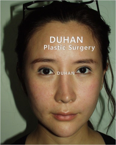 [Duhan Plastic Surgery Double Eyelid Revision] - [Reducing the Double Eyelid Line] image 46