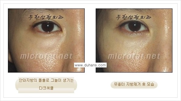 [두한성형외과 경쟁력 눈밑성형] - [눈밑지방제거, 눈위지방제거 안내 2.] 관련 이미지 11