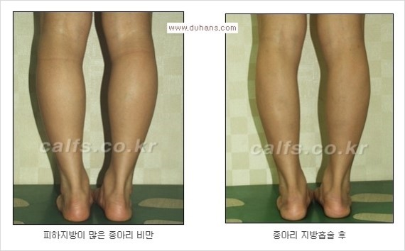 [두한성형외과 경쟁력 종아리성형 리더] - [종아리 성형 안내] 관련 이미지 13