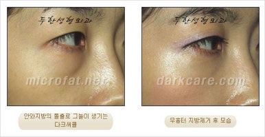 두한성형외과 눈밑수술 - 다크서클 수술 전후 관리 안내 관련 이미지 56