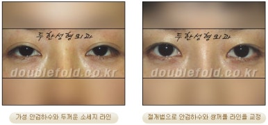 [Duhan Plastic Surgery Double Eyelid Revision Surgery] - [Ptosis, sausage eyelids] image 17