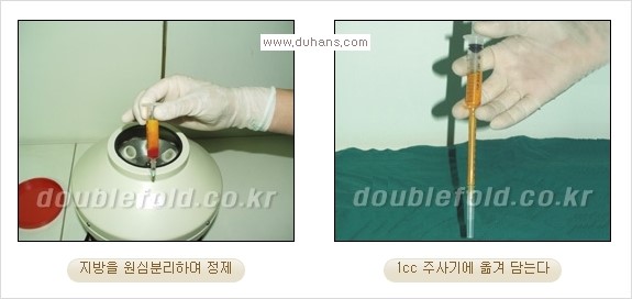 [두한성형외과 경쟁력 눈성형] - [삼중(세겹) 쌍꺼풀 라인의 교정] 관련 이미지 14